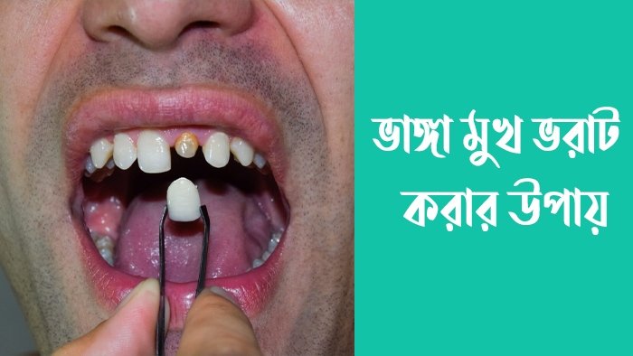 ভাঙ্গা মুখ ভরাট করার উপায়